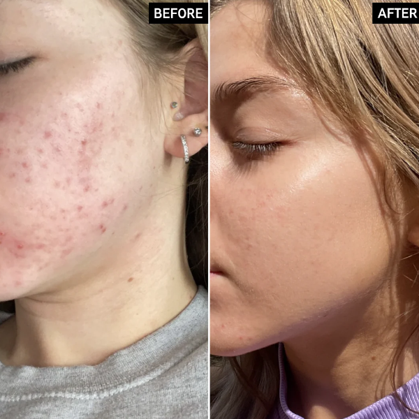 The Inkey List Niacinamide Serum 30Ml - Imagen 4